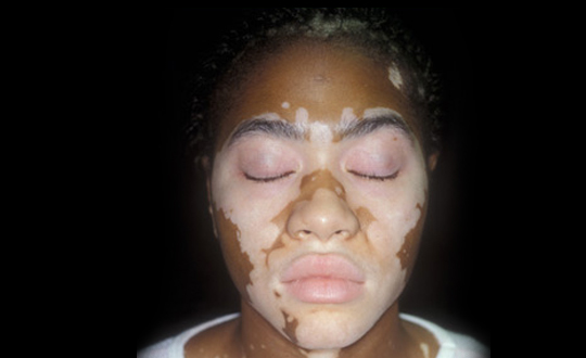 Vitiligo hastal tarih oluyor
