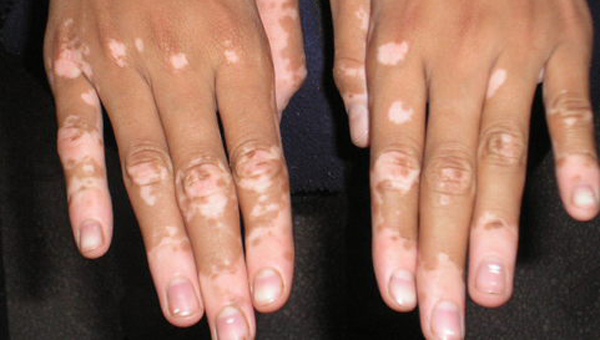 Vitiligo hastalar� i�in yeni umut