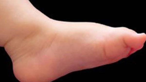 arpk bacaklar tamamen tedavi edilebilir