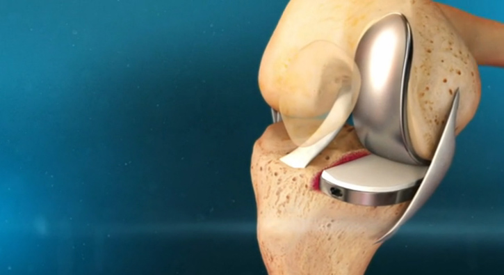 Ak�ll� diz protezinde T�rk imzas�