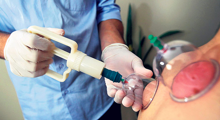 Hacamat art�k hastanelerde yap�lacak