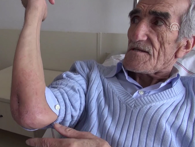 Dirsek ak�nt�s� �ikayetiyle ba�vurdu verem ��kt�