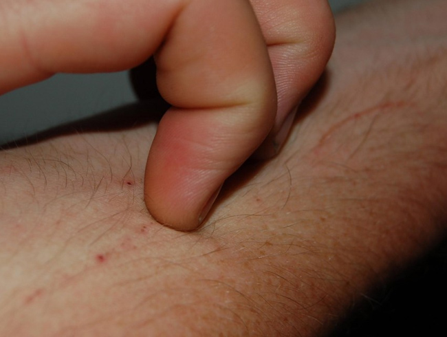 Bitlis'te uyuz alarm�!