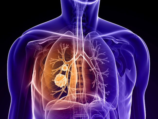 KOAH hastalar� Coil ameliyat�yla nefes al�yor