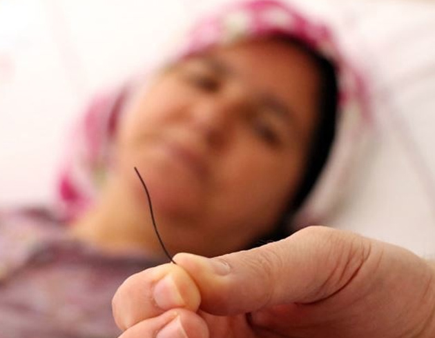 Petek bal yedi, midesinden 10 santimlik tel kt