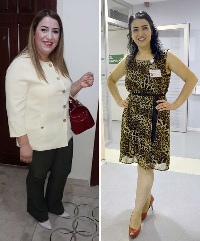 30 yandaki Esma obezite cerrahisiyle 110 kilodan 65 kiloya indi