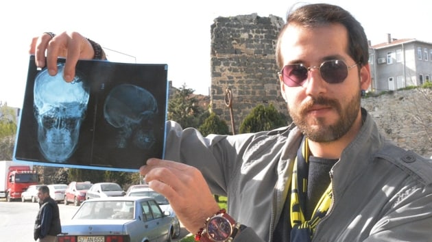 Sinop'ta bir kii 26 yldr beynindeki dile yayor