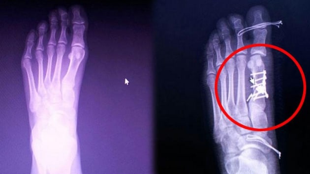Krk ayak parma yerine salam parma ameliyat edildi