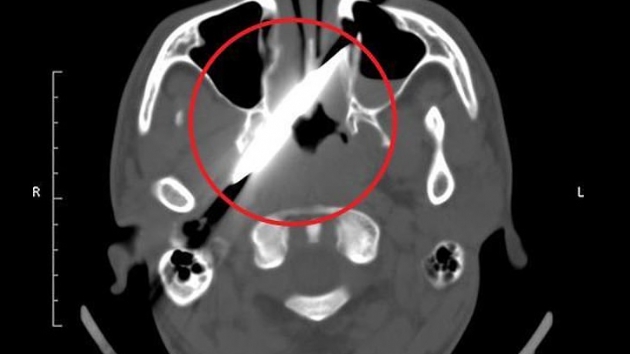 4 gn kafasnda bakla gezdi