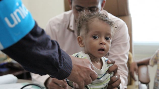 'Yemen'de yaklak 85 bin ocuk yetersiz beslenmeden lm  olabilir' 