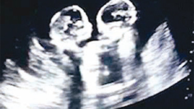 Anne karnnda dven ikizler dounca duruldu