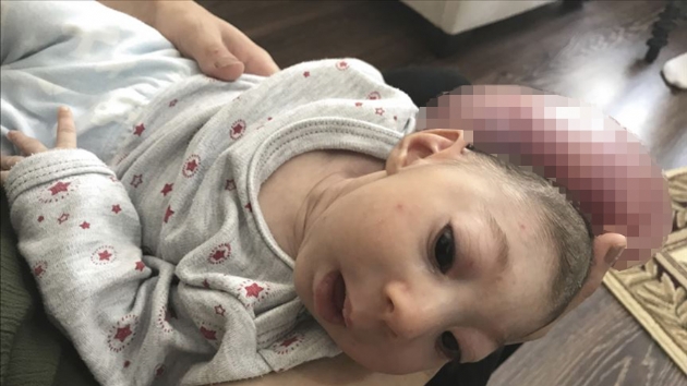 Kafasnda kitleyle doan bebeklerinin ameliyat edilmesini istiyorlar
