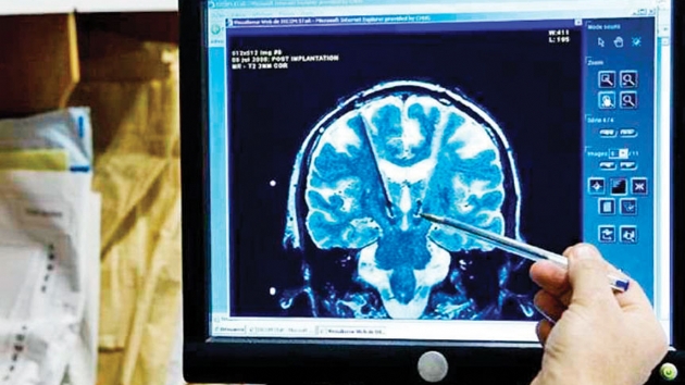 inde Alzheimer ilacna onay kt