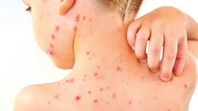 Samoa'da kzamk salgn: 6 l