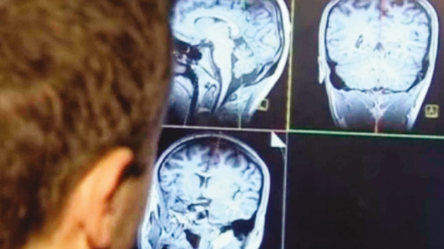 Beyin kendini yeniden yaplandrabiliyor