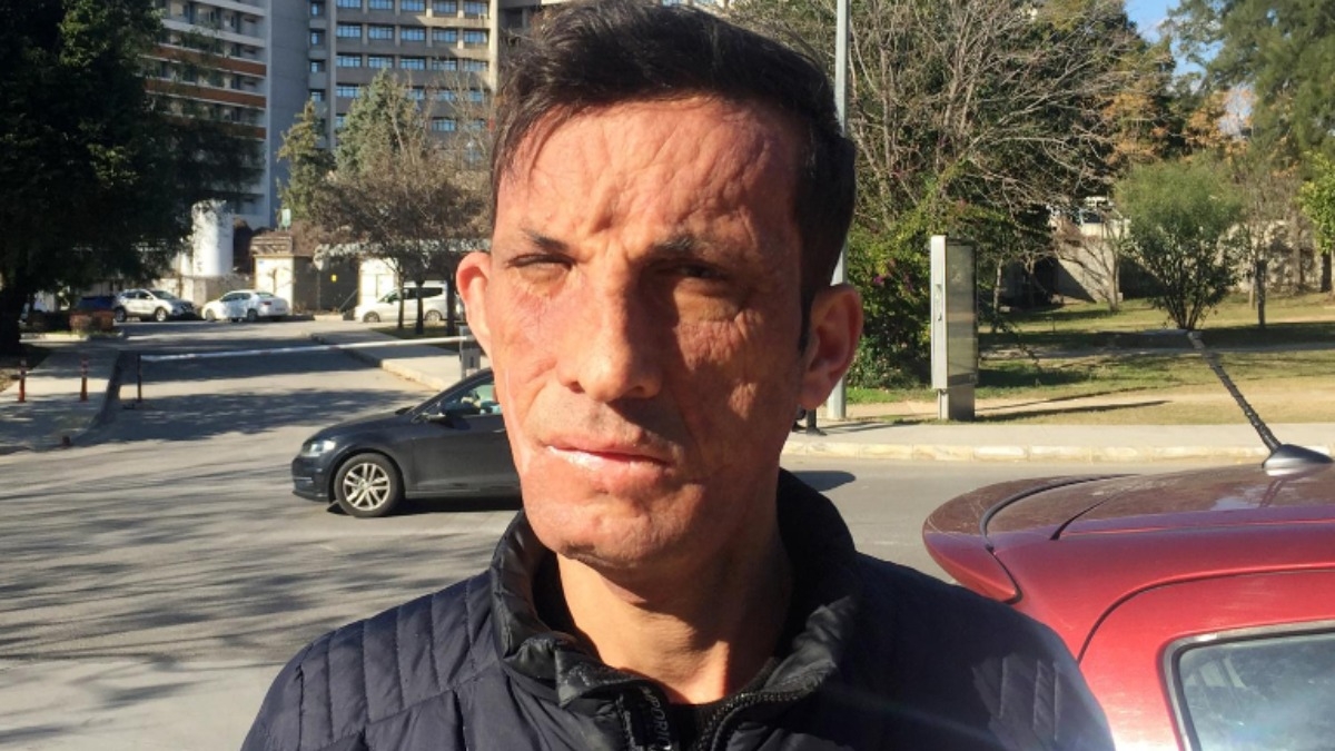 Trkiye'nin ilk yz nakillisi Uur Acar: Tek isteim evlenmek