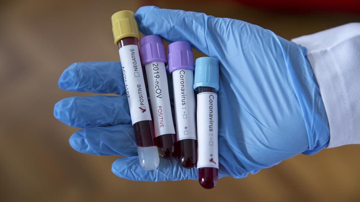CDC Direktr Dr. Robert Redfield: 4 hastadan biri koronavirs belirtilerini gstermiyor