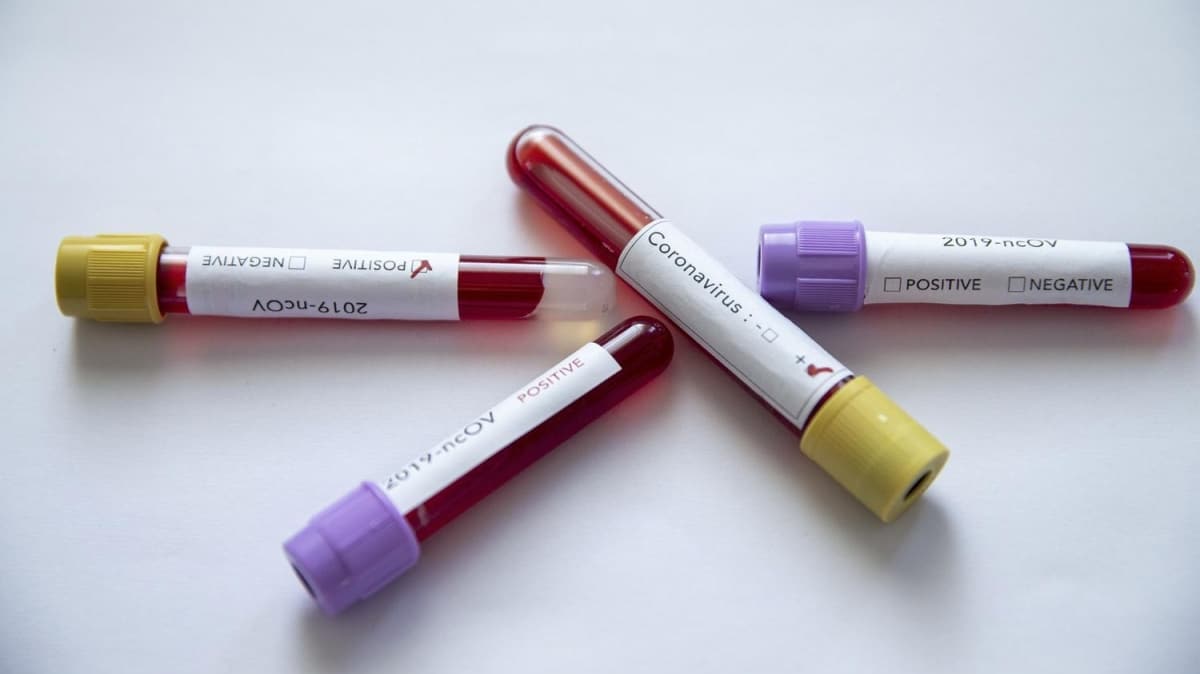 Brezilya'da koronavirs vaka says 178 bini at