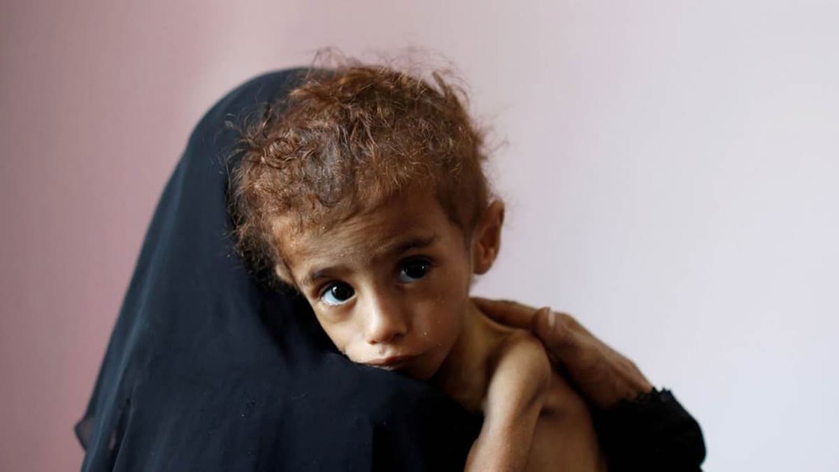 DS: Yemen'de 23 binden fazla ocuk bulac hastalklara kar aland 