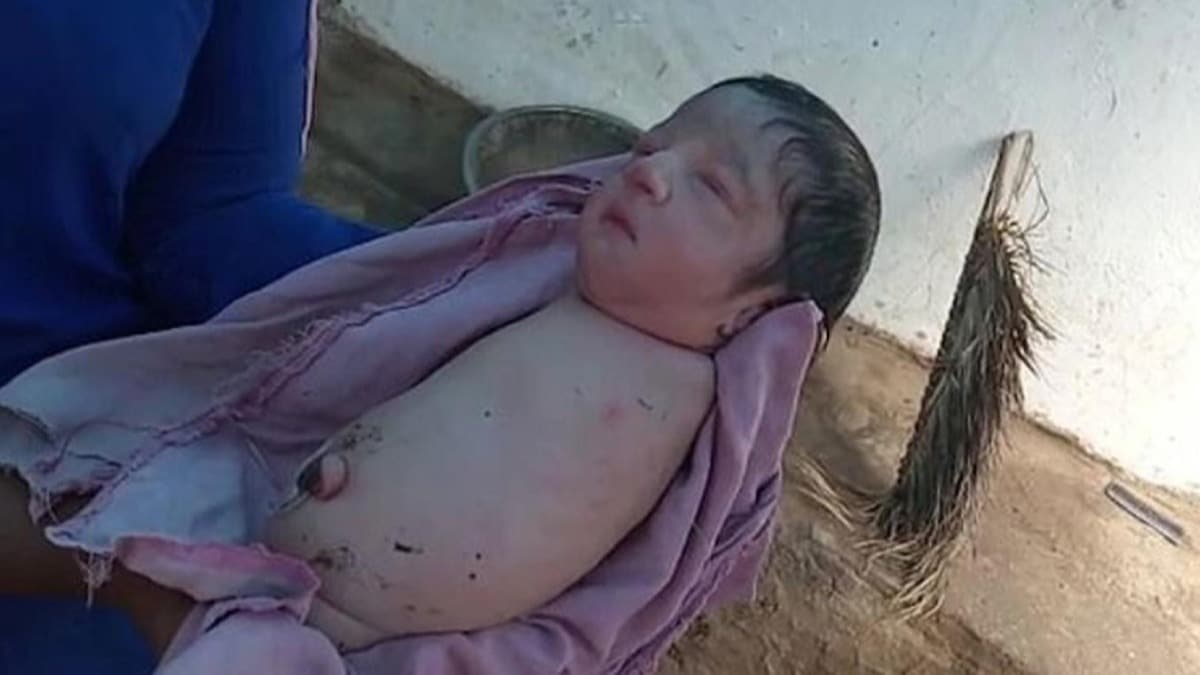 Hindistan'da kollar ve bacaklar olmadan doan bebek aknl