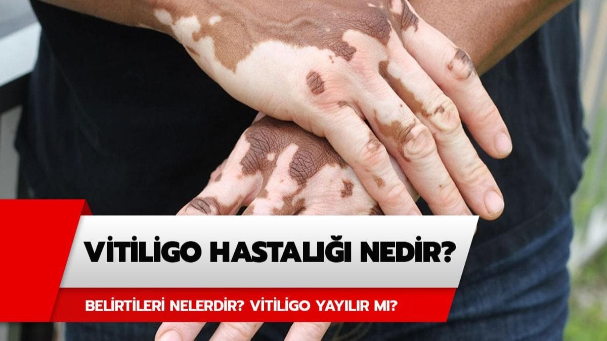 Vitiligo hastal nedir? Vitiligo hastal yaylr m?