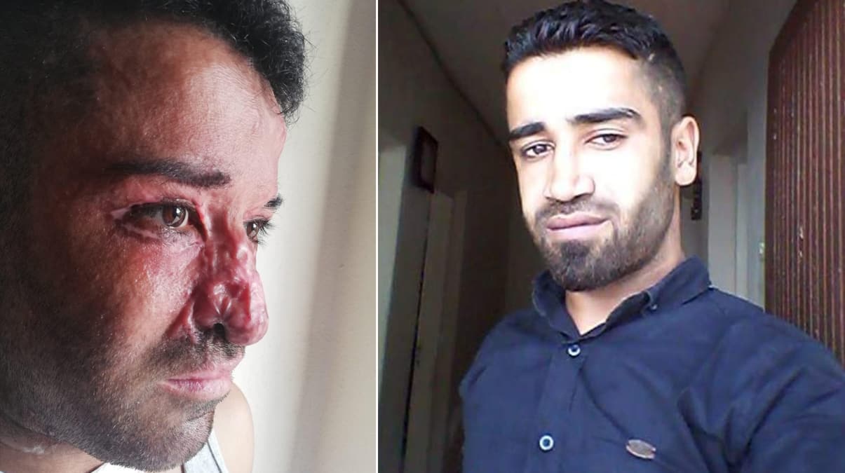 5 dakikada y�z� bu hale geldi