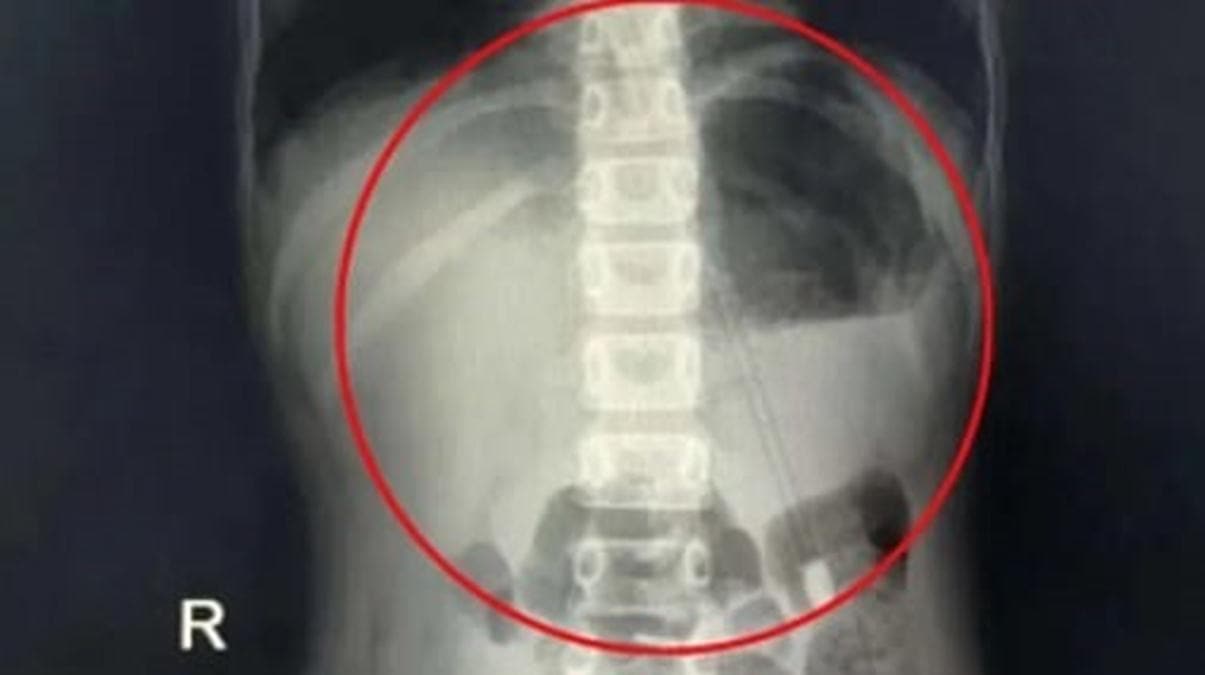 7 ya��ndaki �ocuk 18 cm'lik kalem yuttu