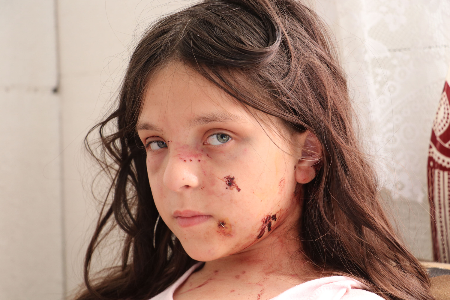 Pitbull sald�r�s�na u�rayan �ocuk deh�eti ya�ad�: 60 diki� at�ld�