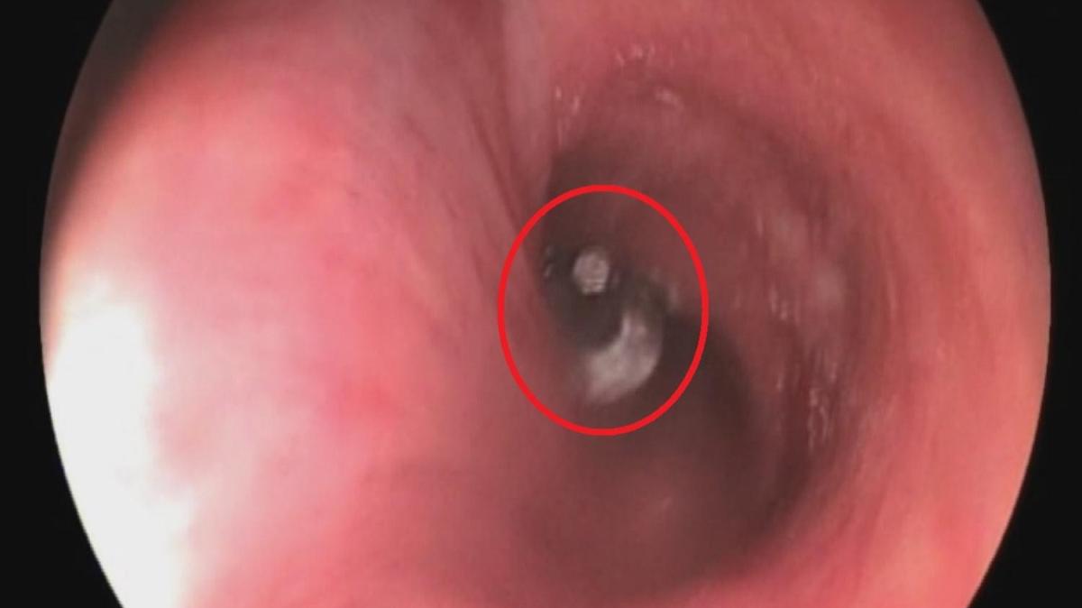 Ameliyat anbean kaydedildi! Diide akcierine implant paras kat 