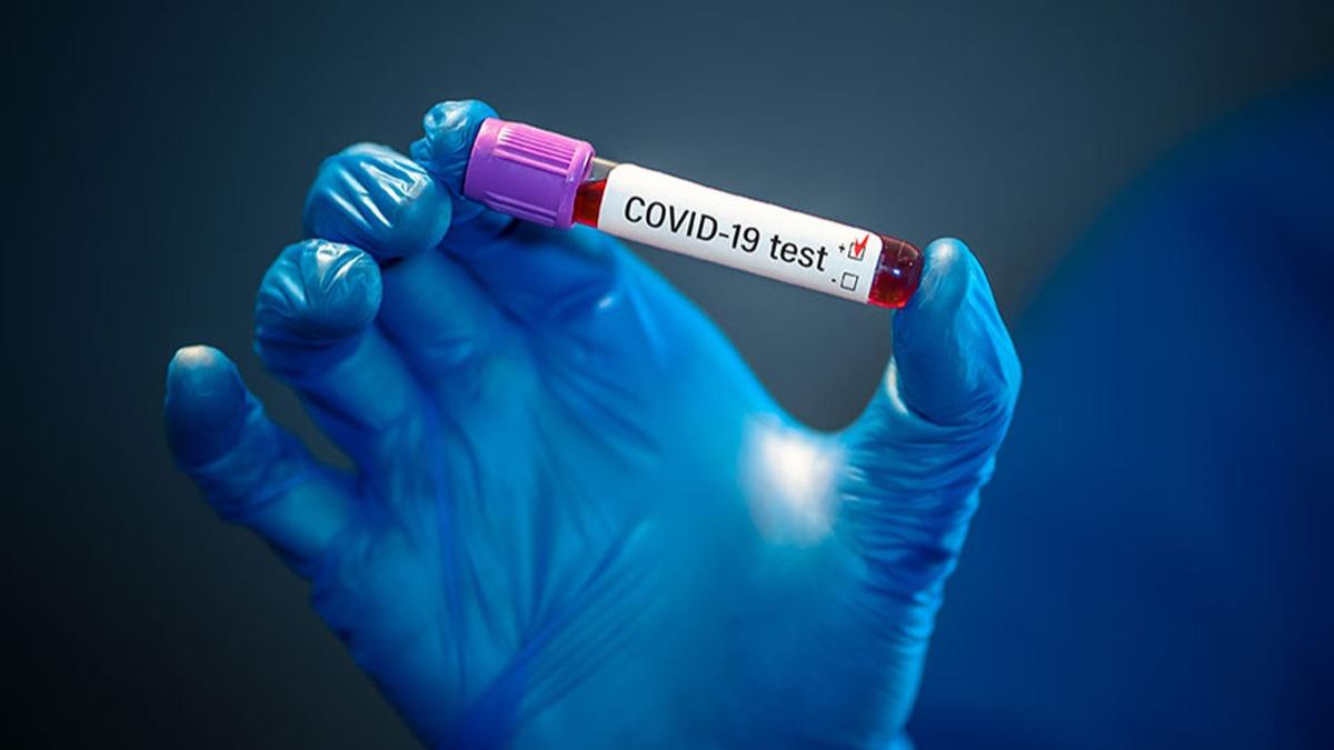 Covid-19'la ilgili arpc aratrma: 1 yl sonra bile var
