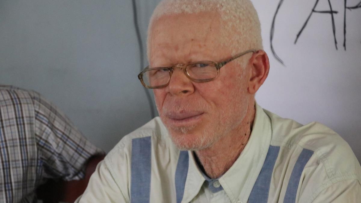 Kamerun'da albinoslar tehdit altnda