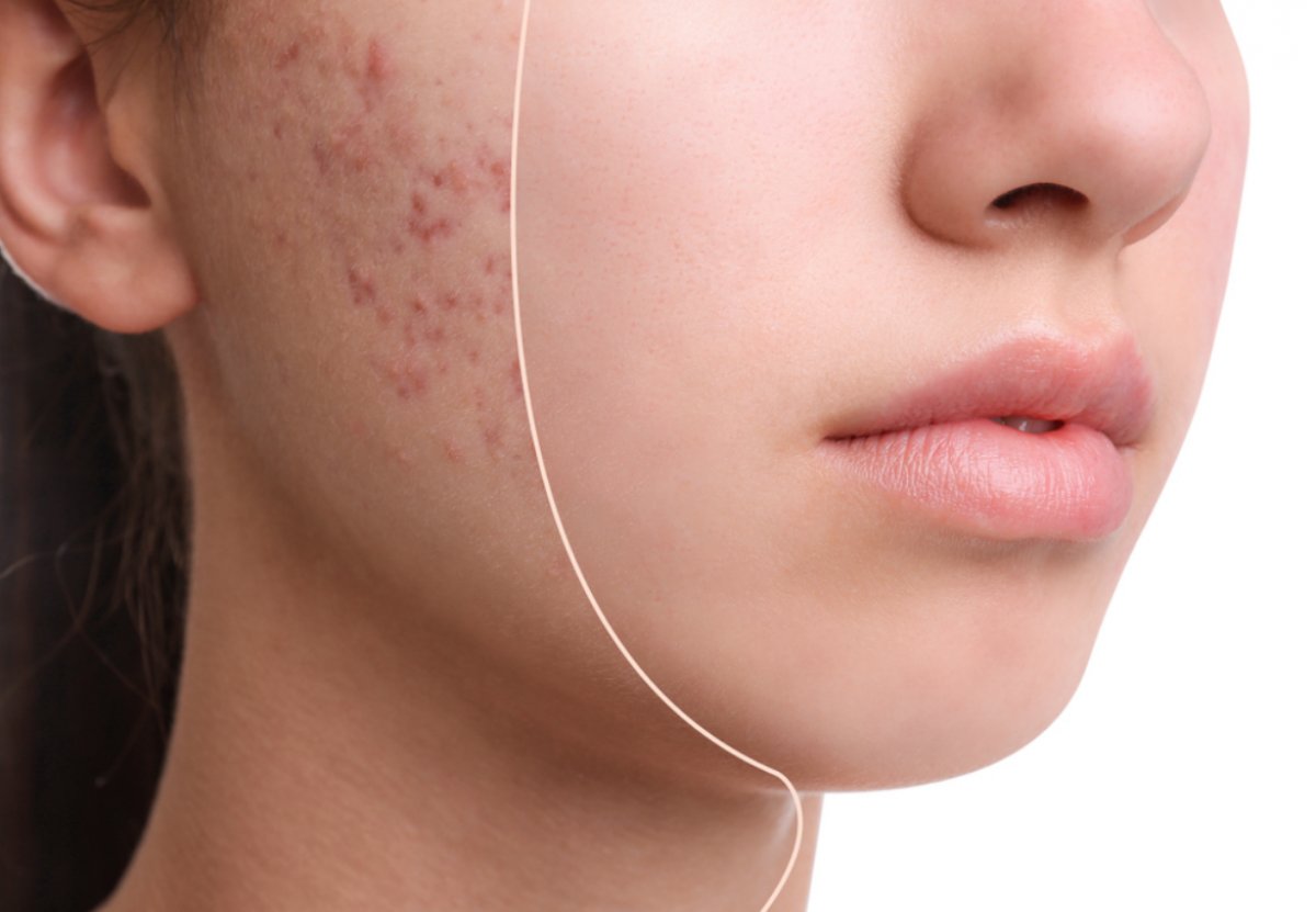 Akne probleminiz varsa bu yiyeceklerden uzak durun!