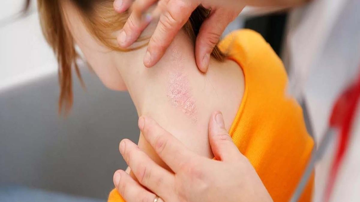 Bitkisel karm 'Sedef hastal'na ifa oldu