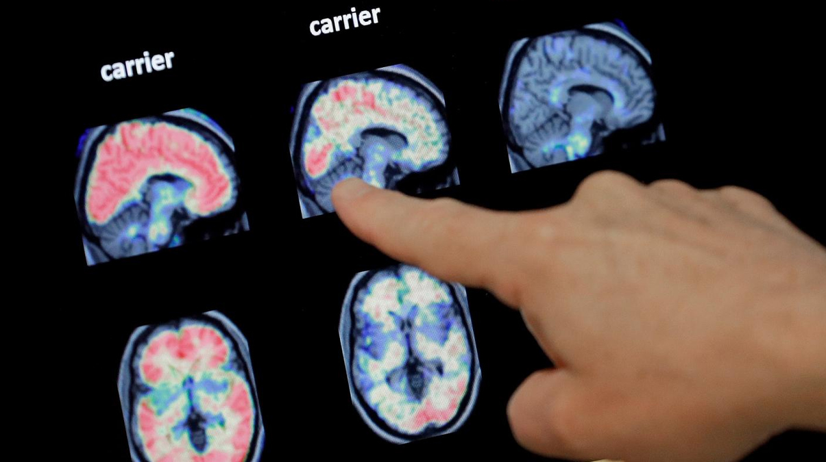 Kovid-19 ge�irenlerin beyni k���l�yor