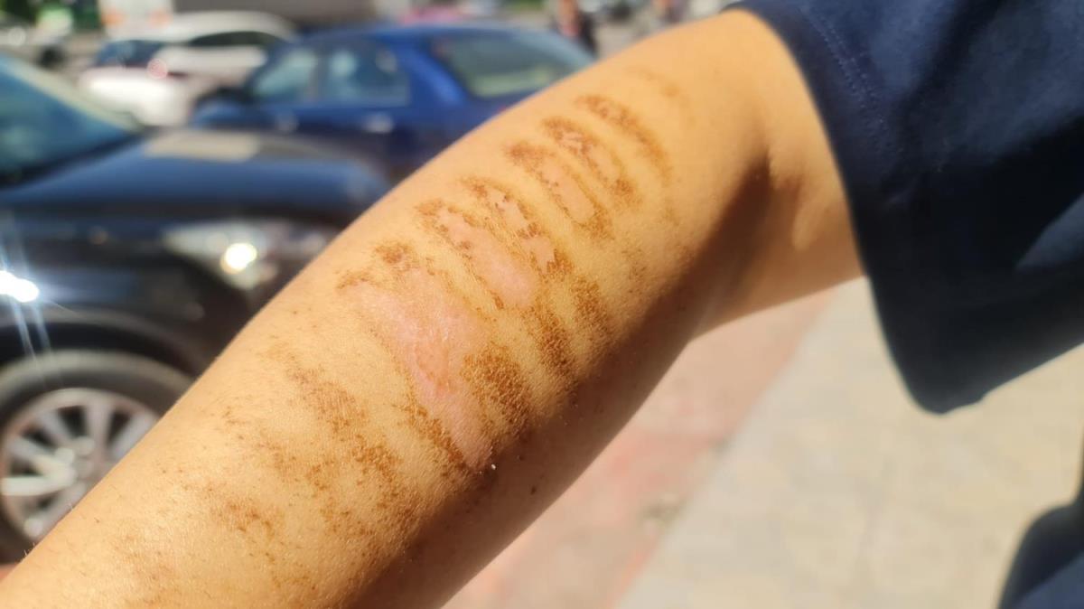 Feci olay: Epilasyon sonras kollar bu hale geldi!