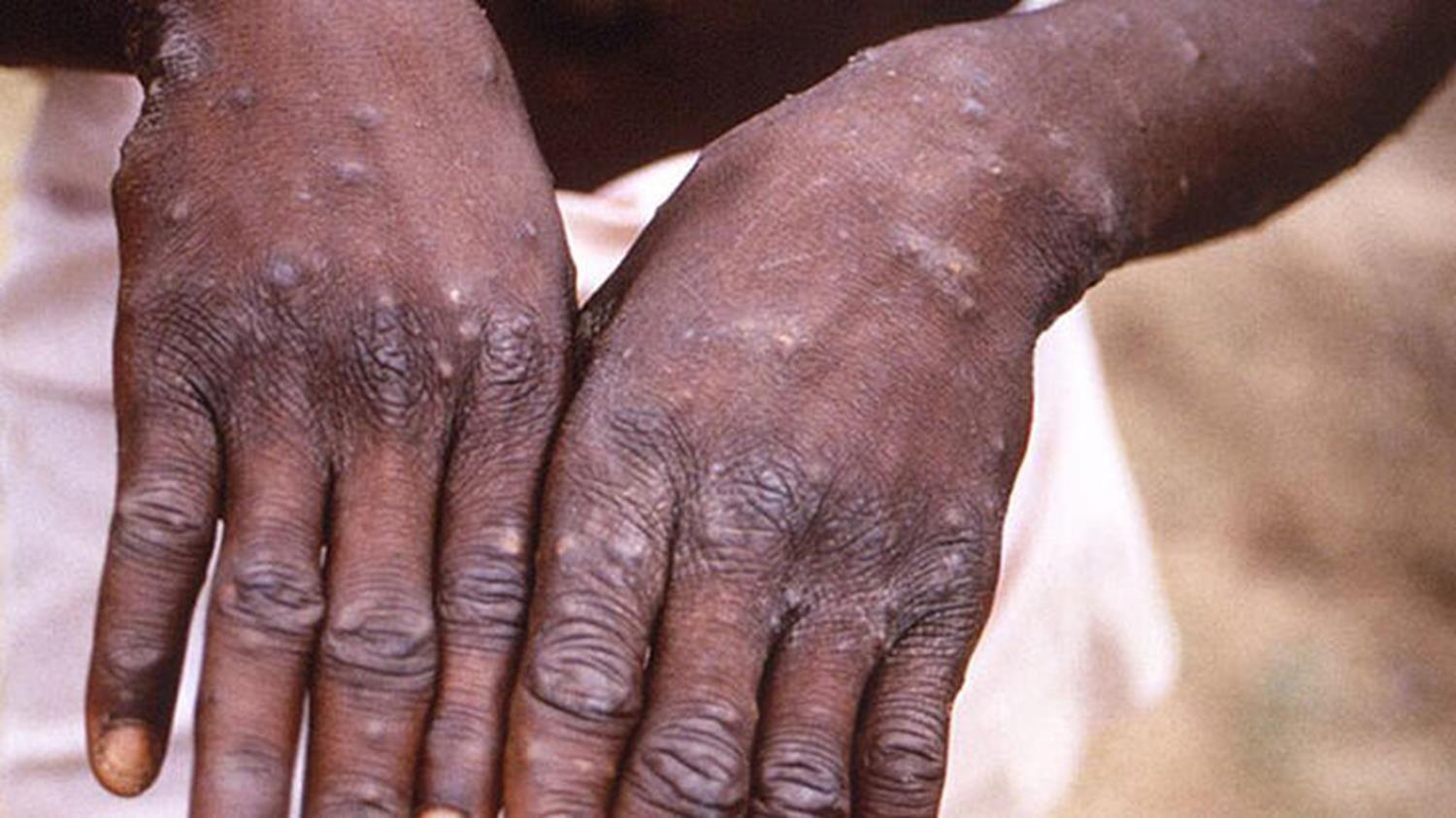 Uzmanlardan rahatlatan a��klama: Maymun �i�e�inin �l�m oran� d���k