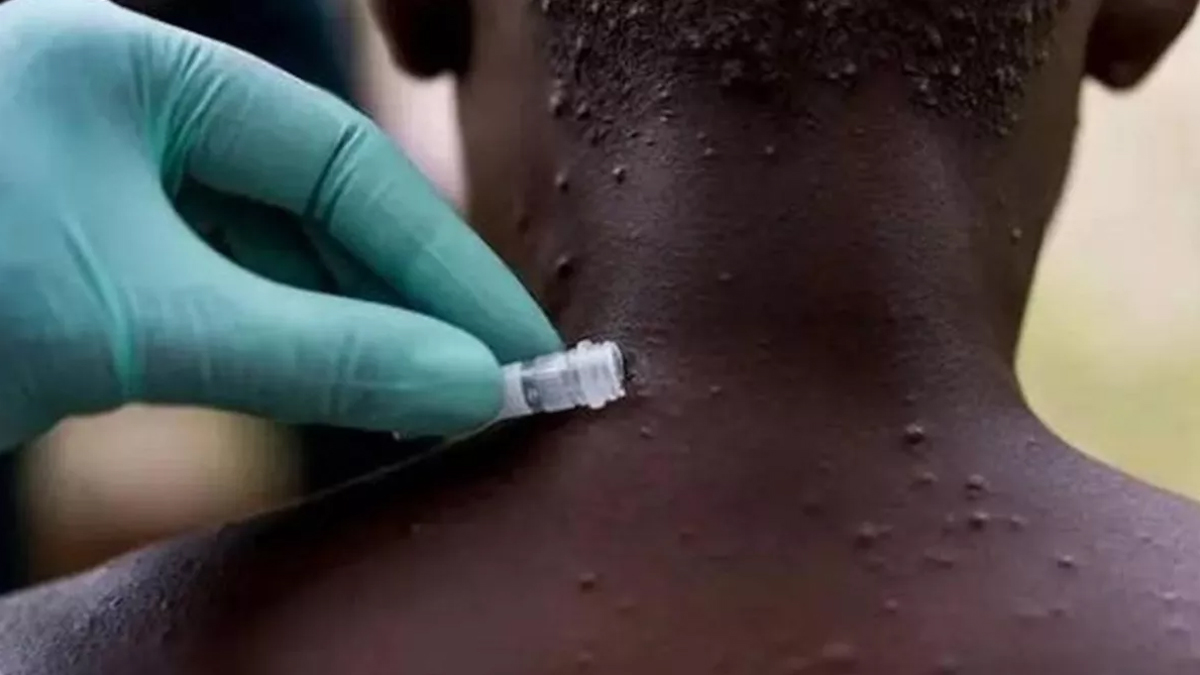 �ngiltere'de maymun �i�e�i vakas� art�yor