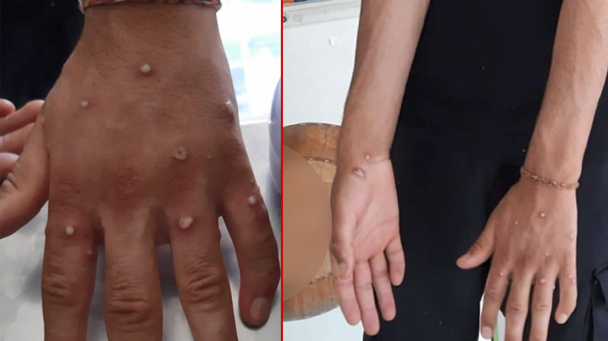 �stanbul'da 'maymun �i�e�i' alarm�!