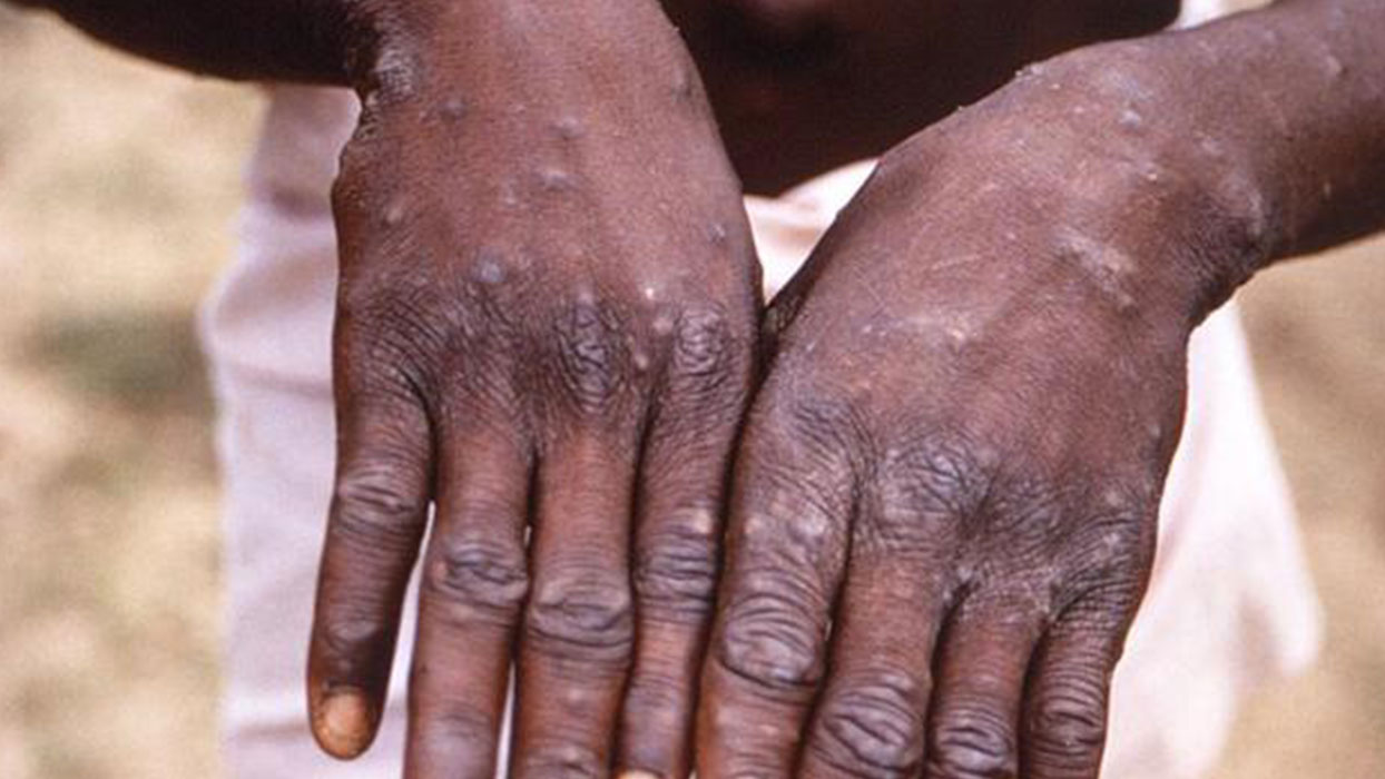 Nijerya'da bir haftada 10 ki�ide maymun �i�e�i vakas� g�r�ld�