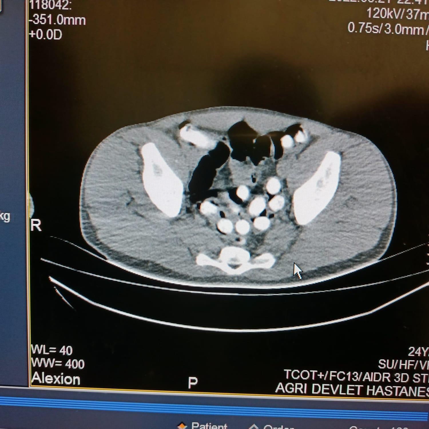 �ranl� yolcunun midesinden 102 kaps�l halinde 1 kilo 126 gram afyon sak�z� ��kar�ld�