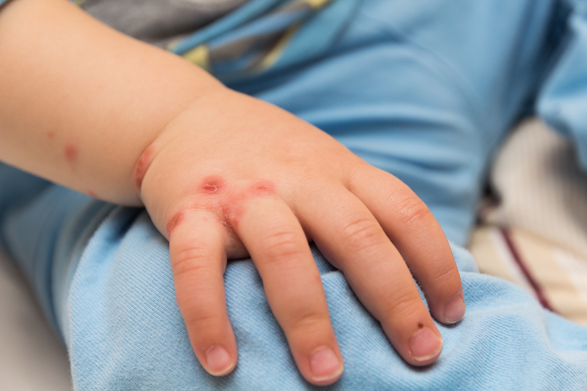 Uzmanlardan sevindirecek 'maymun �i�e�i vir�s�' a��klamas�: Pandemi boyutuna ula�mayacak