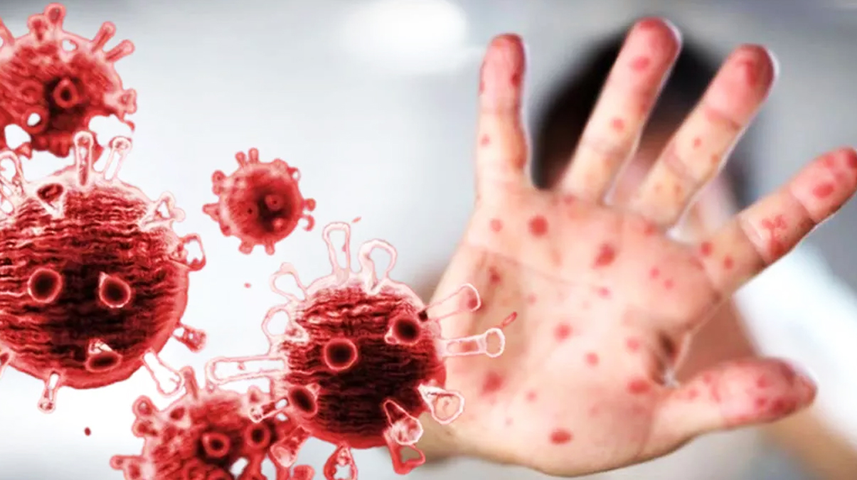 DS�'ye g�re d�nya genelinde maymun �i�e�inden 3 ki�i �ld�