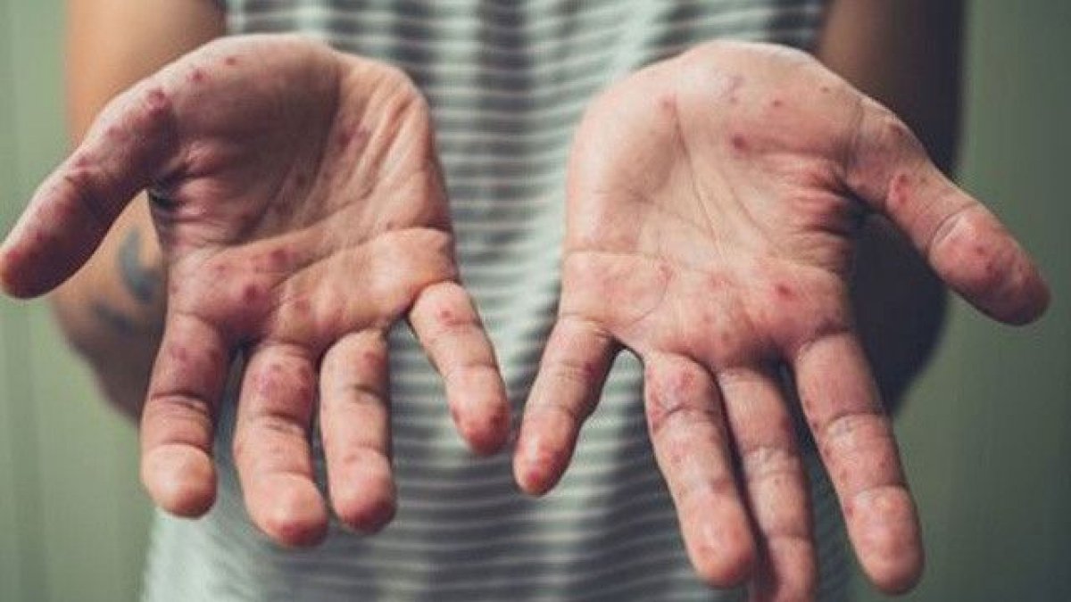 ABD'de ilk kez �ocuklar aras�nda maymun �i�e�i vir�s� g�r�ld�