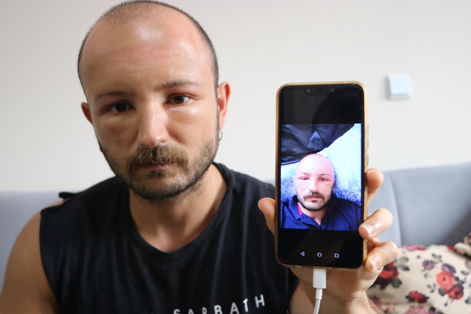2 g�n plaja gitti! Nadir g�r�len bir hastal��a yakaland�