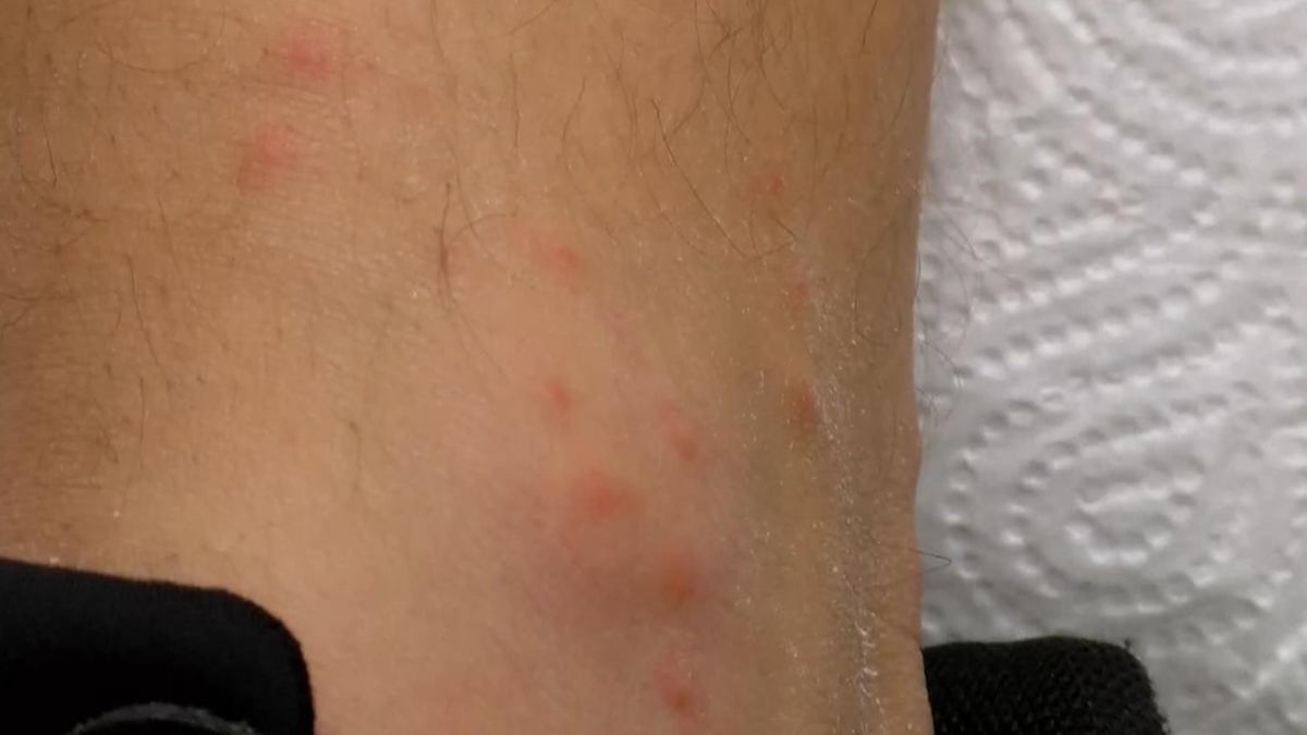 stanbul'da sivrisinek tehlikesi: Hastaneye bavurular artt