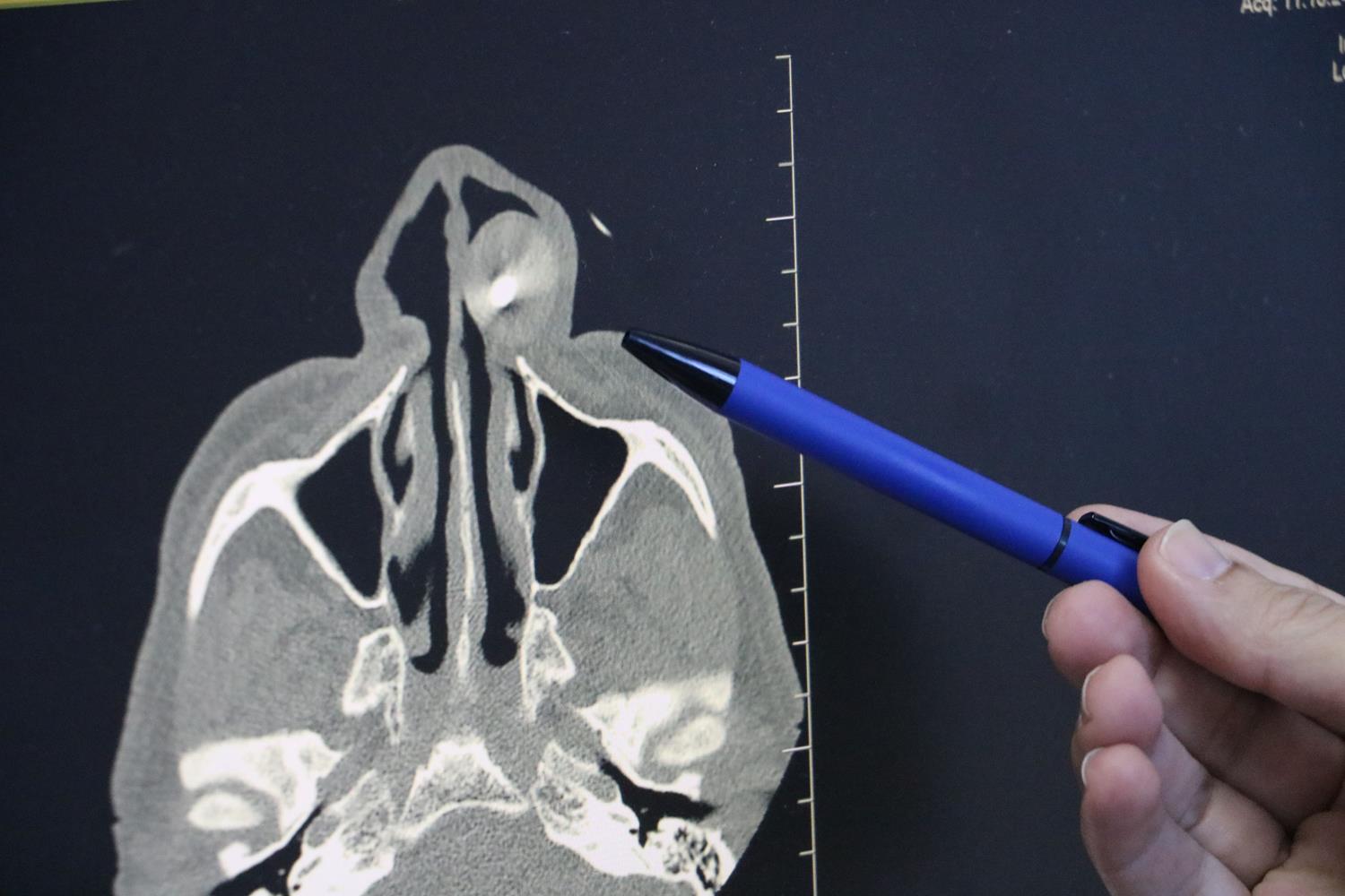 50 yldr yzndeydi: Ameliyatla alnd