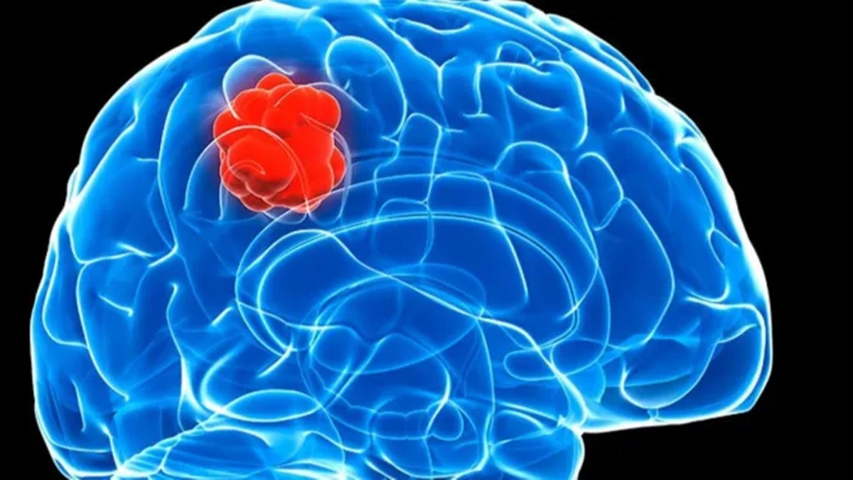 Yaygn grlen bir beyin tmrnn 3 alt tr tespit edildi