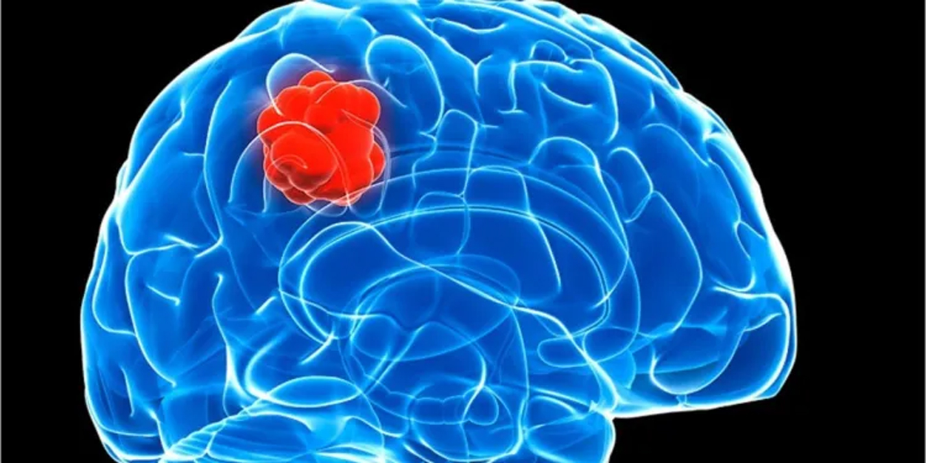 Yaygn grlen bir beyin tmrnn 3 alt tr tespit edildi