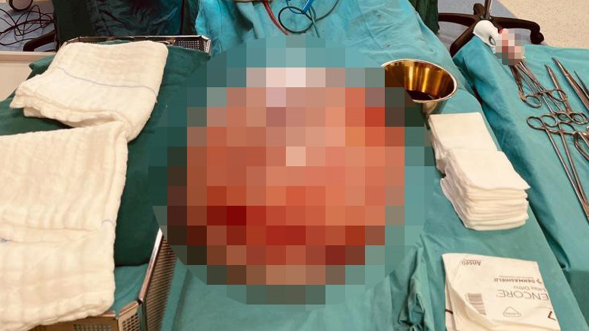 Hamile olduğunu düşündü: 15 kilo kist çıktı 